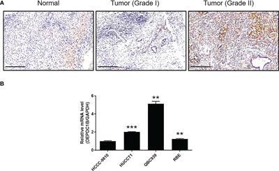 DEPDC1B promotes development of cholangiocarcinoma through enhancing the stability of CDK1 and regulating malignant phenotypes